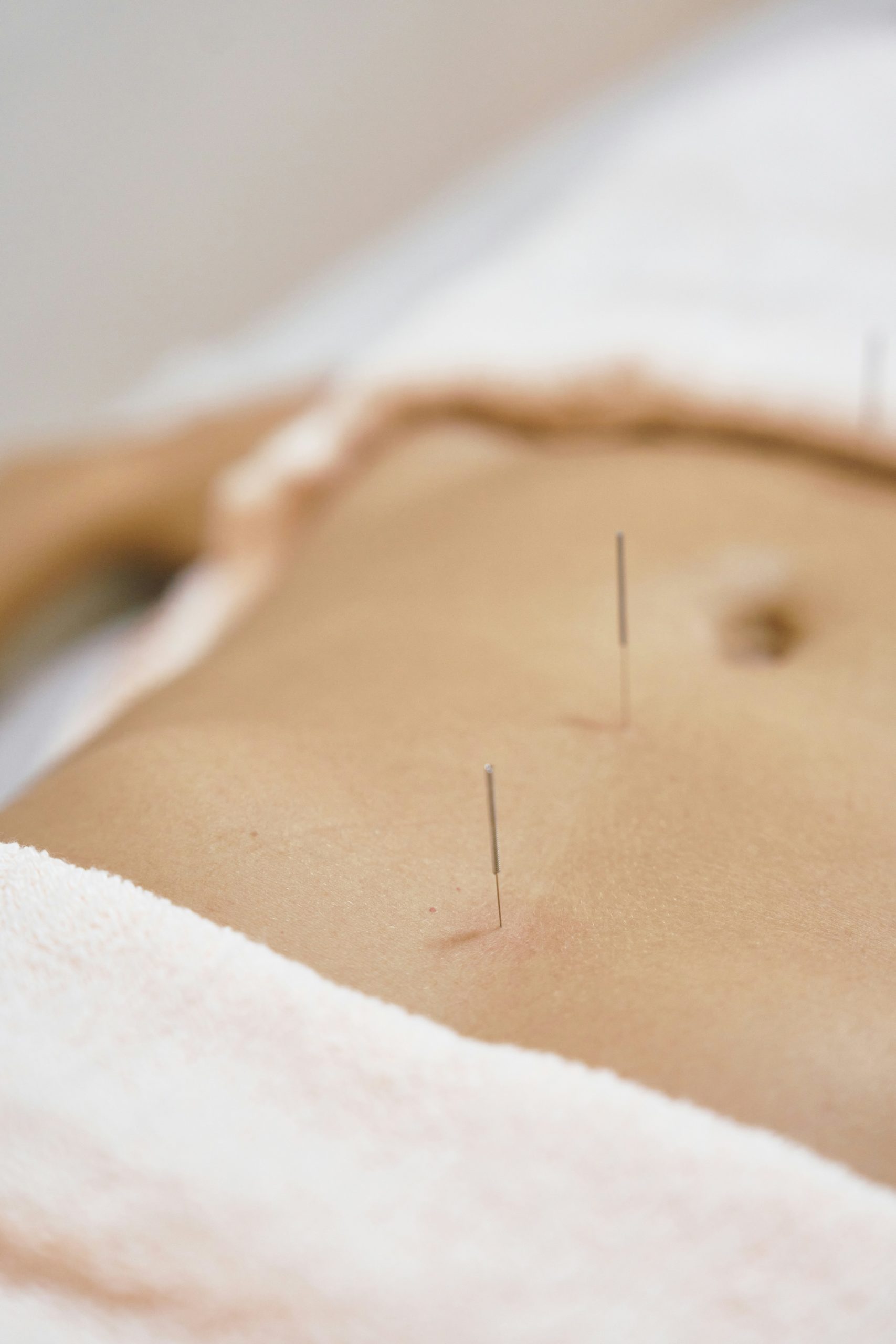 Acupuncture sur le ventre pour la perte de poids